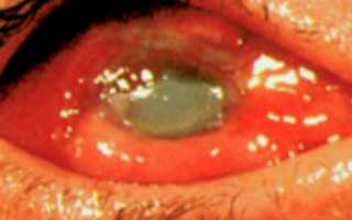 Химический ожог глаза: неотложное лечение