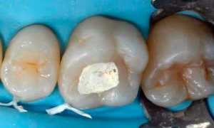 Использование мышьяка при лечении зубов