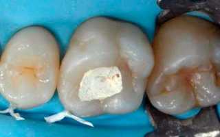 Использование мышьяка при лечении зубов