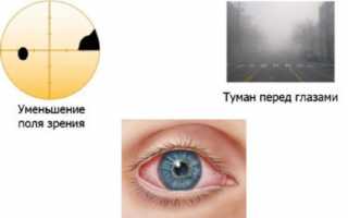 Иглоукалывание, точки при глаукоме: массаж для глаз
