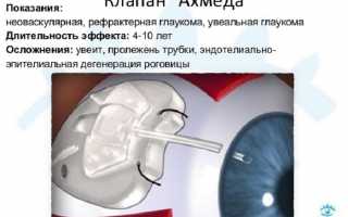 Клапан Ахмеда при глаукоме: эффективность операции