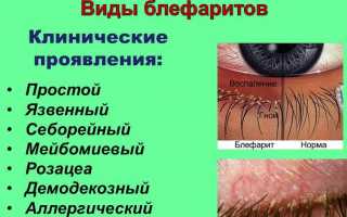 Чешуйчатый блефарит: как распознать среди других видов блефарита и не запустить заболевания.