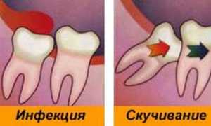 Что делать с дистопированным зубом когда он «не на своем месте»