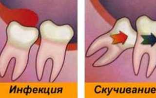 Что делать с дистопированным зубом когда он «не на своем месте»