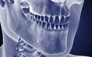 Опасность промедления при остеомиелите челюсти