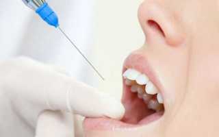 Применение ультракаина в стоматологии