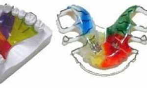 Зубные пластинки — безопасный и безболезненный способ исправления прикуса