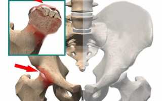 Осложнения при переломах шейки бедра: последствия развития