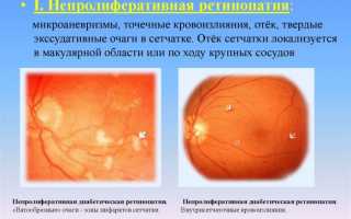 Диабетическая ретинопатия непролиферативная – признаки и причины