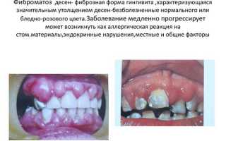 Диагностика и лечение гиперплазии десен