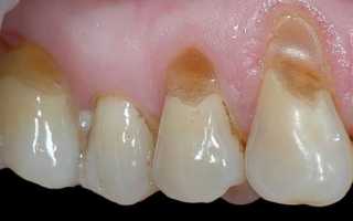 Причины и способы лечения клиновидного дефекта зубов