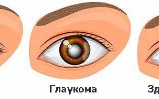 Причины и профилактика катаракты и глаукомы глаз: как сохранить зрение?