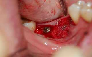 Всё о боли при имплантации зубных имплантов