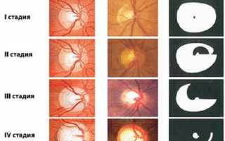 Восстановление зрительного нерва при глаукоме: методы лечения