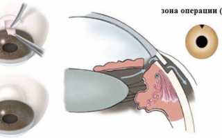 Глаукома – операция по удалению заболевания, осложнения