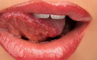 Распространенные виды глоссита языка и методы лечения