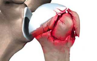 Вколоченный перелом шейки плеча: особенности травмы