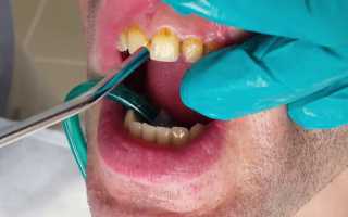 Причины возникновения и методы лечения кисты зуба