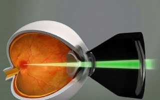 Макулодистрофия сетчатки глаза: симптомы, диагностика, лечение