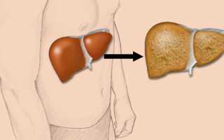 Что такое стеатоз печени и какое лечение необходимо для избавления от жировой дистрофии этого органа?