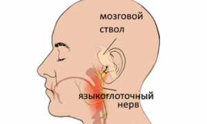 Как лечить воспаление языкоглоточного нерва