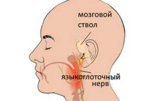 Как лечить воспаление языкоглоточного нерва