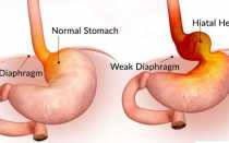 Аксиальная грыжа пищеводного отверстия диафрагмы