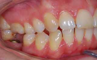 Временные протезы зубов как способ избавления от беззубости
