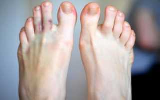 Перелом пальца на ноге: как и чем лечить