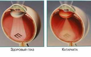 Как предупредить катаракту глаз и избежать осложнений?