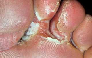 Запущенный грибок на ногтях и коже: чем опасен и как лечить?