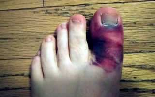 Перелом пальцев ноги: особенности травмы