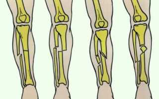 Винтовой перелом голени: симптоматика и лечение