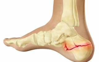 Осколочный перелом пятки: помощь и реабилитация