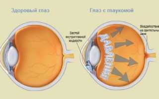 Массаж при глаукоме: рекомендации и противопоказания, упражнения для глаз