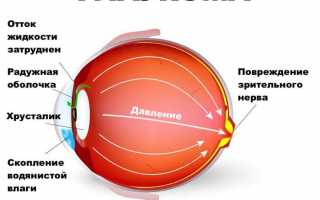 Боль в глазу при глаукоме: симптомы и лечение