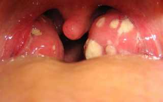 Грибок в горле (фарингомикоз, кандидоз горла) у взрослых и детей: причины, симптомы и методы лечения