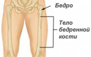 Перелом бедра со смещением: особенности травмы и способы лечения