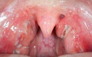 Стафилококк в горле у ребенка – симптомы и лечение детей