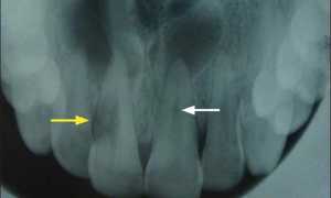 Причины внешней и внутренней резорбции корня зуба