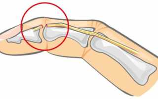 Перелом указательного пальца руки: причины и способы лечения