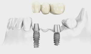 Выбор между зубным мостом и имплантом
