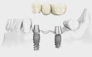 Выбор между зубным мостом и имплантом