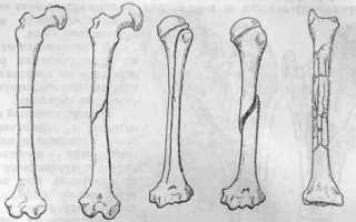 Переломы диафиза плечевой кости: диагностика и лечение