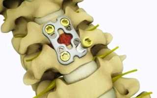 Патологический перелом позвоночника: причины и лечение