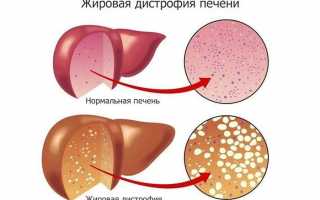 Жировой гепатоз с диффузными изменениями в печени