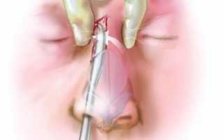 Операция при переломе носа со смещением: показания к проведению