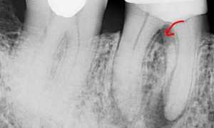 Перфорация или по-простому дырка в зубе