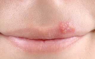 Простуда на губах: лечение и причины