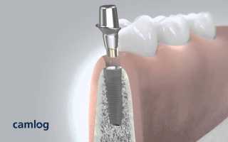 8 главных достоинств зубных имплантов Camlog